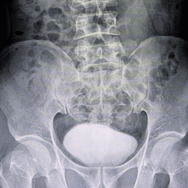 Voiding Cystourethrograms scan